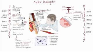 Enterovirus Meningitis Springboard