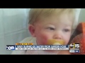 boy burned by garden hose