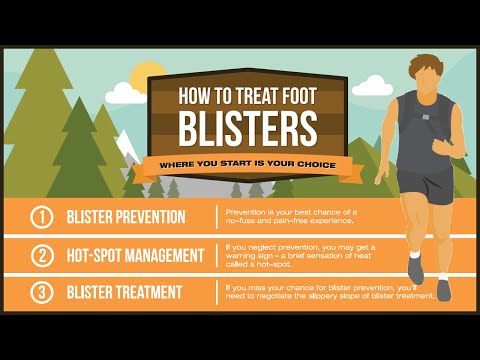 How To Treat Your Foot Blister (Like A Pro)! How To Treat Your Foot Blister (Like A Pro)!