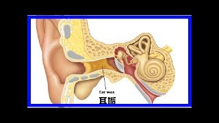 「耳鼻喉科」教授告訴你：「耳垢」不是垢！三要訣：別掏、別挖、別清理！