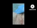 My dog first cyst operation see how many in one operation,most commonly sick of an old dog.CYST