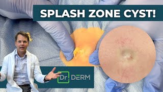 Splash Zone Cyst! | Dr. Derm