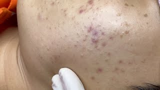 Treating Teen Acne | Điều Trị Mụn Cho Bạn Nam Tuổi Dậy Thì - SacDepSpa#317