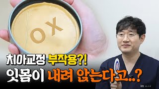 치아교정을 하면 잇몸이 내려앉는다? OX