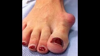 Crazy Tips for the FASTEST Possible Bunion Surgery Recovery!