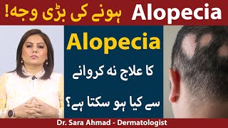 Alopecia: Causes and Treatment In Urdu/Hindi | Baalchar Ka ilaj | Alopecia Ka Ilaj