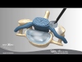 posterior cervical foraminotomy at swift institute in reno carson sparks northern nevada