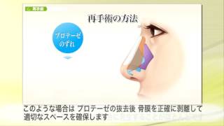 【東京美容外科】わかりやすい“鼻”の解説33「鼻の再手術プロテーゼのずれ」