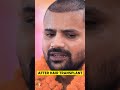 youtuber topa bhai nadeem bunny hair transplant progress shorts hairtransplant