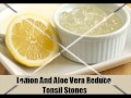 10 Best Ways How To Get Rid Of Tonsil Stones 10 Best Ways How To Get Rid Of Tonsil Stones
