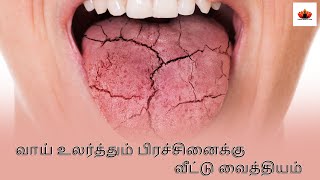 வாய் உலர்த்தும் பிரச்சினைக்கு வீட்டு வைத்தியம் HomeRemedy For Dry mouth in Tamil | Tamil Health Tips