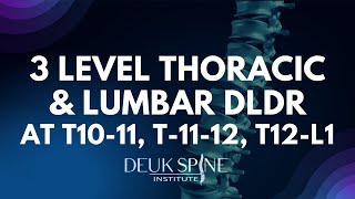 3 Level DLDR at T10-11, T-11-12, T12-L1 of the Thoracic and Lumbar Spine