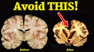 Minimize Your Risk of CTE in MMA (Part 3/3)