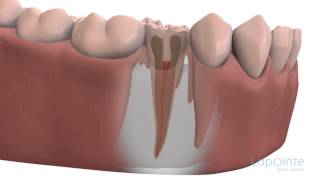 Apectomy - Lapointe dental centres