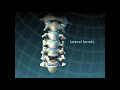 Cervical Disc Replacement