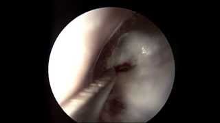 Endoscopic Myringotomy (Ear Drainage)