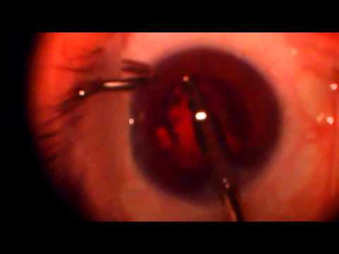 Cataract Surgery 2 - YouTube