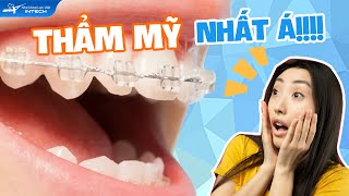 “Truy Tìm” Mắc Cài Niềng Răng Thẩm Mỹ Nhất? Kết Quả Sẽ Khiến Bạn Không Ngờ!!!