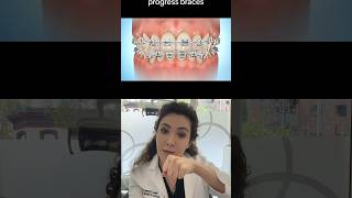 How Can Orthodontic Elastics Help With Your Braces