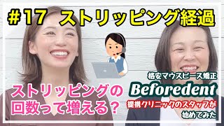 【Beforedentマウスピース矯正はじめました#17】