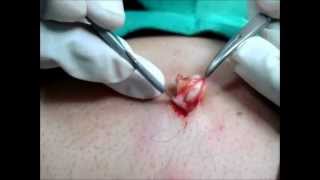 Complete Cyst Removal - A Technique To Watch