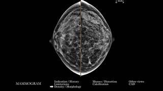 [MM] Mammogram (and Breast Tomosynthesis) | Search Pattern