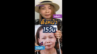 ดึงหน้าแค่ 15 วัน ลดอายุมาก พี่น้ำทิพย์คนไทยในเดนมาร์ก ธีรพรคลินิก หมอชลธิศ