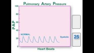 livingwithph.ca -  PA PRESSURE GRAPHS