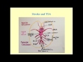 Stroke and TIA - CRASH! Medical Review Series