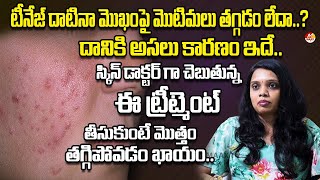 టీనేజ్ దాటినా మొఖంపై మొటిమలు తగ్గడం లేదా? | Causes of Adult Acne (and How to Get Rid of It) | Maaxtv