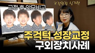 주걱턱 성장교정 구외장치 사례, 어린이 성장시기 교정 고민이라면?