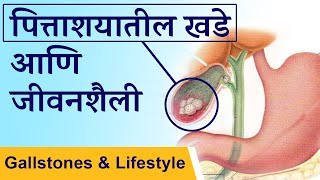 पित्ताशयातील खडे आणि जीवनशैली | Gall stones and lifestyle | By - Dr. Tejas Limaye | Marathi |