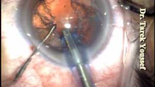 Routine Phacoemulsification 2009