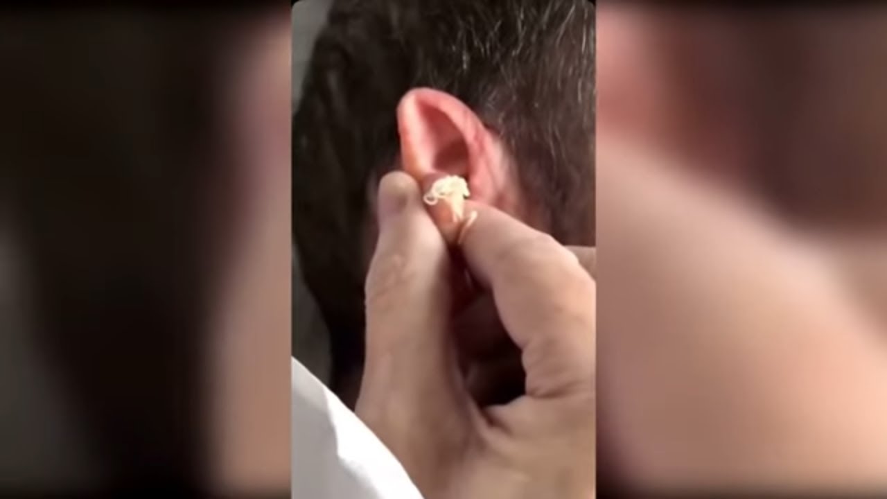 Popping huge blackheads and Pimple Popping - Best Pimple Popping Videos #37