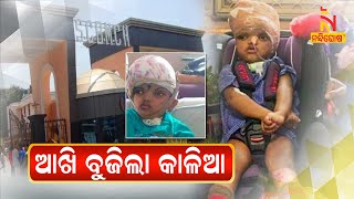 Kandhamal's Separated Conjoined Twin Kalia Dies At Cuttack SCB | NandighoshaTV