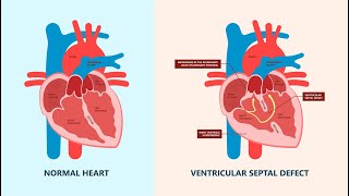 Ventricular septal defect (VSD)