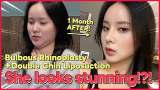 [Plastic Surgery REVIEW] Asian Rhinoplasty+Double Chin Liposuction in Korea #abplasticsurgery