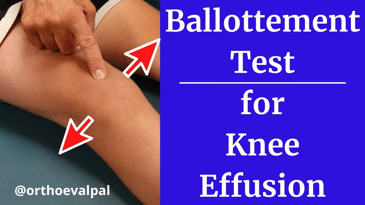Ballottement Test For Effusion In The Knee Youtube