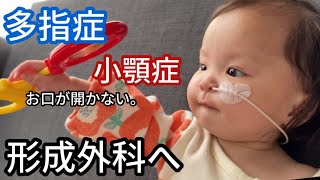 【4pマイナス症候群】多指症と1㎝しか開かないお口をみてもらいました。