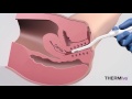 thermiva® nonsurgical vaginal rejuvenation in shreveport the wall center