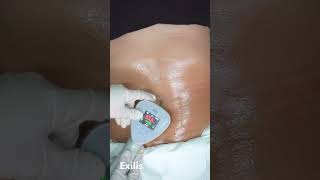 #Exilis #treatment #bodytreatment #karmalite #fatloss