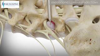 02 Endoscopic Lumbar Discectomy