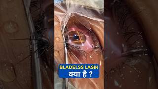 What Is Bladeless Lasik?