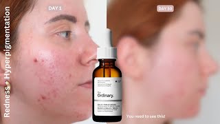 30 Days Of...The Ordinary Aloe 2% + NAG 2% Blemish Solution | Hyperpigmentation \u0026 Redness