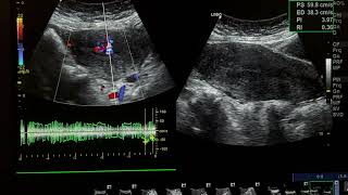 RPOCs in a 40 years old woman with pervaginal bleeding