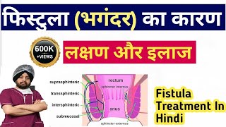 Fistula, in Hindi, Definition, Symptoms, Treatment, Surgery, How Fistula Cure Without Surgery