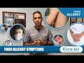 Food Allergy Symptoms [Chacko Allergy]