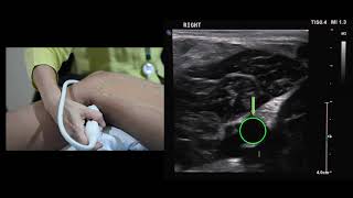 การตรวจหลอดเลือดดําของขา Color Doppler Ultrasound of Deep Vein Lower Extremity