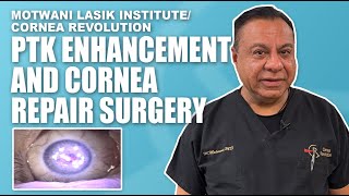 PTK Surgery and Cornea Repair Enhancing