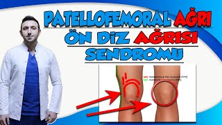 Ön Diz Ağrısı Tedavisi/ Ön Diz Ağrısı Nedenleri / Patellofemoral Ağrı